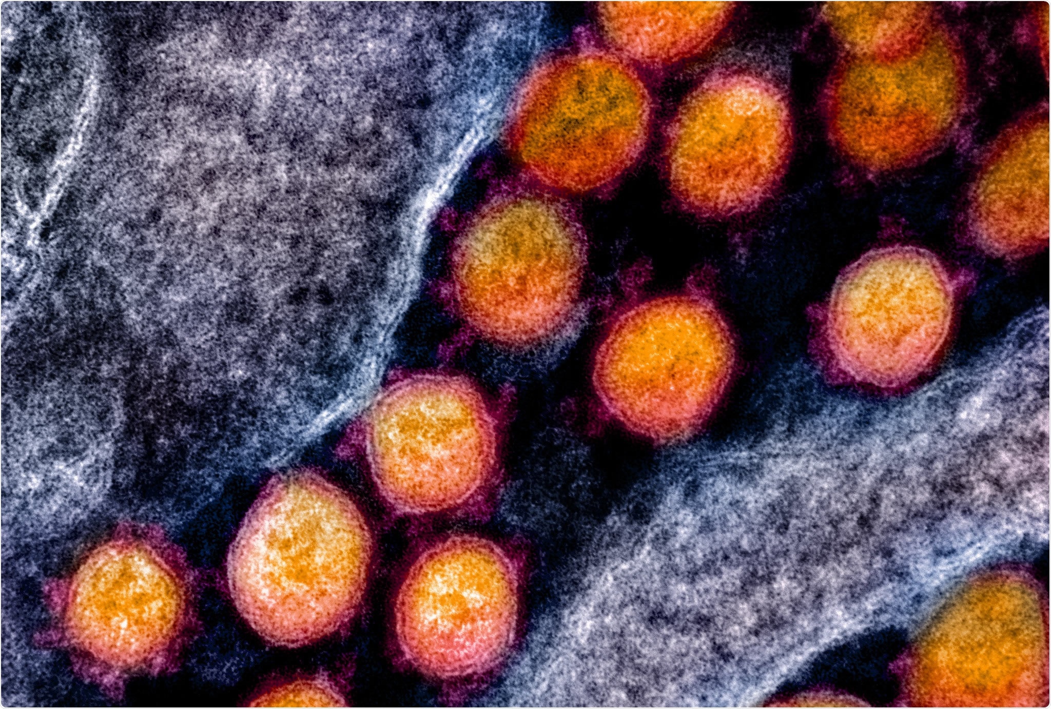 Transmission electron micrograph of SARS-CoV-2 virus particles, isolated from a patient. Image captured and color-enhanced at the NIAID Integrated Research Facility (IRF) in Fort Detrick, Maryland. Credit: NIAID