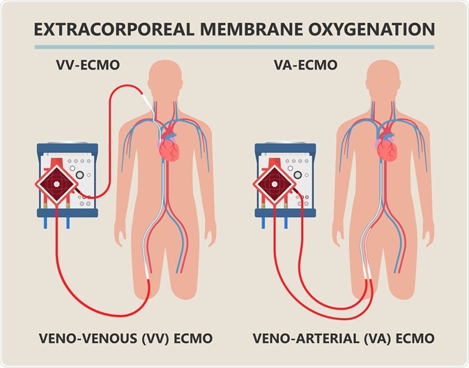 ECMO