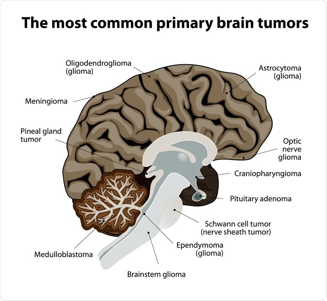 brain tumors