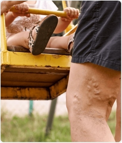 How to get rid of varicose veins