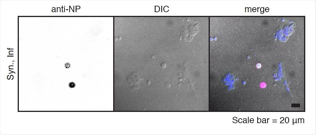SARS-CoV-2 infection of primary syncytiotrophoblasts. Primary syncytiotrophoblasts were derived from primary isolated cytotrophoblasts allowed to spontaneously differentiate for 72-96 hours. Following the differentiation period, cells were infected at an MOI of 5 for one hour and washed three times with PBS before the addition of fresh media. Shown are two individual cells as detected by immunofluorescence following staining with anti-NP antibody (left panel). Differential interference contrast (DIC, center panel) image shows these two cells are excluded from the surrounding syncytia. Merged image (right panel) shows pseudocolor labeling of syncytialized cells in purple and infected NP-labeled individual cells in pink.