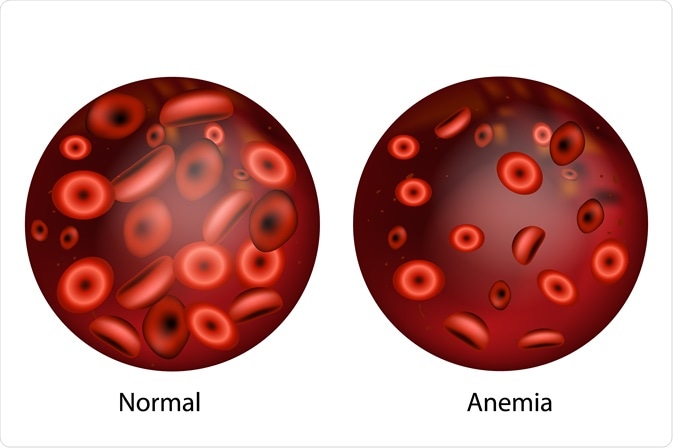 anemia