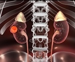 Renal Cell Carcinoma Survival Rate