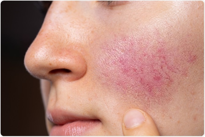 A symptom of rosacea. Image Credit: sruilk / Shutterstock