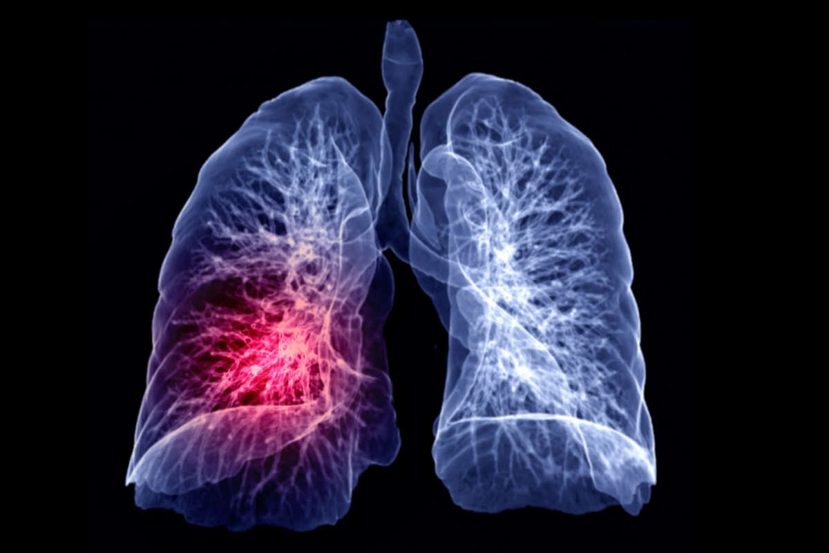 Study: Identification of common key genes and pathways between Covid-19 and lung cancer by using protein-protein interaction network analysis. Image Credit:  samunella / Shutterstock