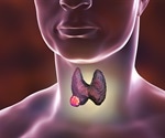 Thyroid Cancer Treatments