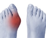 Bunion Symptoms and Complications