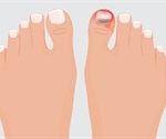 Ingrown Toenail Treatment