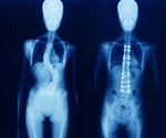 Scoliosis Surgery