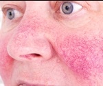 Rosacea and Rhinophyma