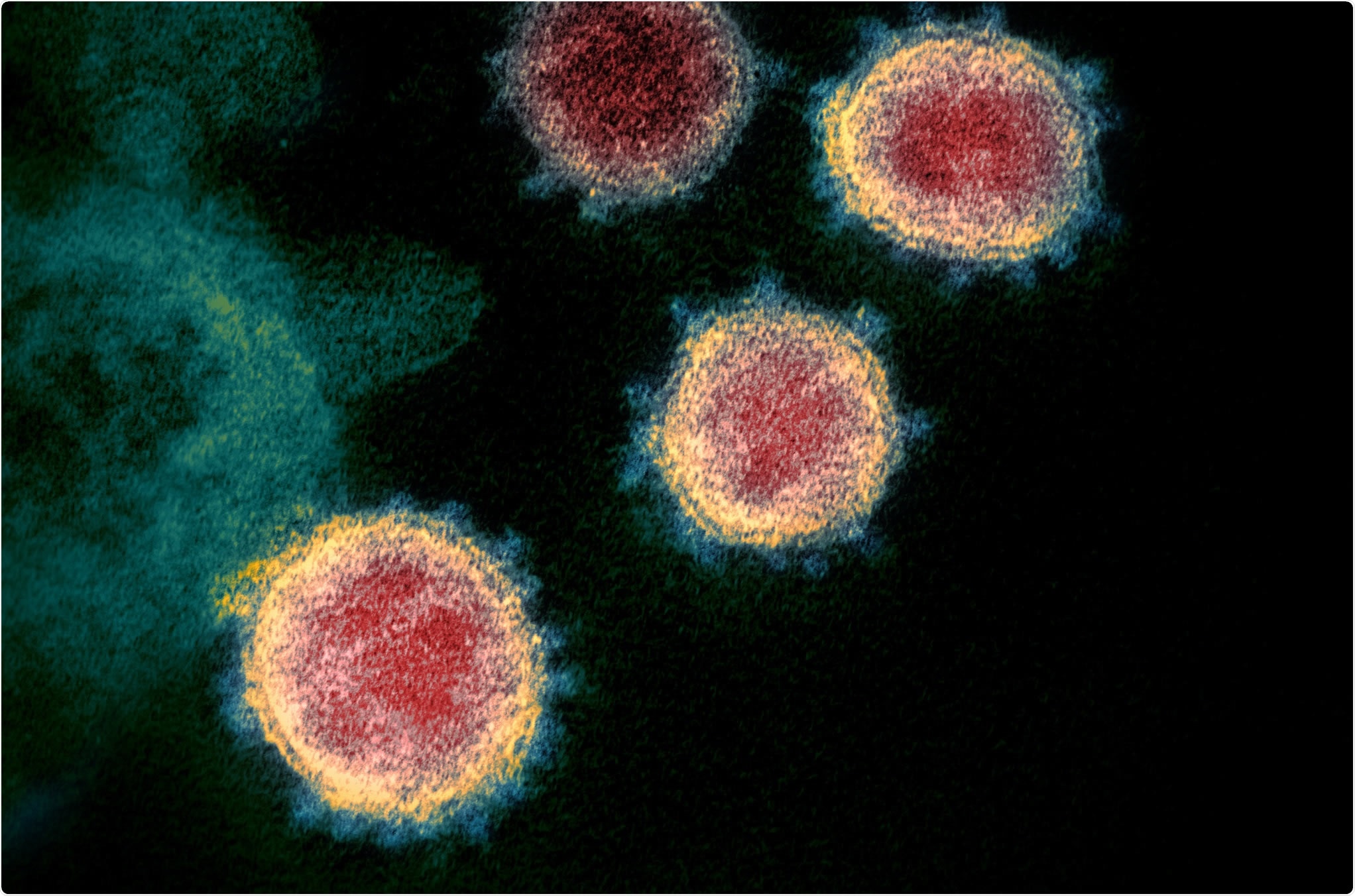 Study: SARS-COV-2 induced Diarrhea is inflammatory, Ca2+ Dependent and involves activation of calcium activated Cl channels. Image Credit: NIAID