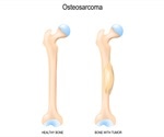 What is Osteosarcoma?