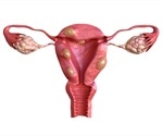 What are Uterine Fibroids?