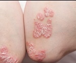 What is Psoriasis?