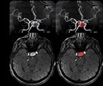 Cerebral Aneurysm Treatment