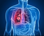 What Causes Lung Cancer in Non-Smokers?
