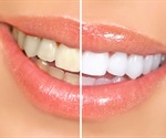 What is Teeth Whitening?