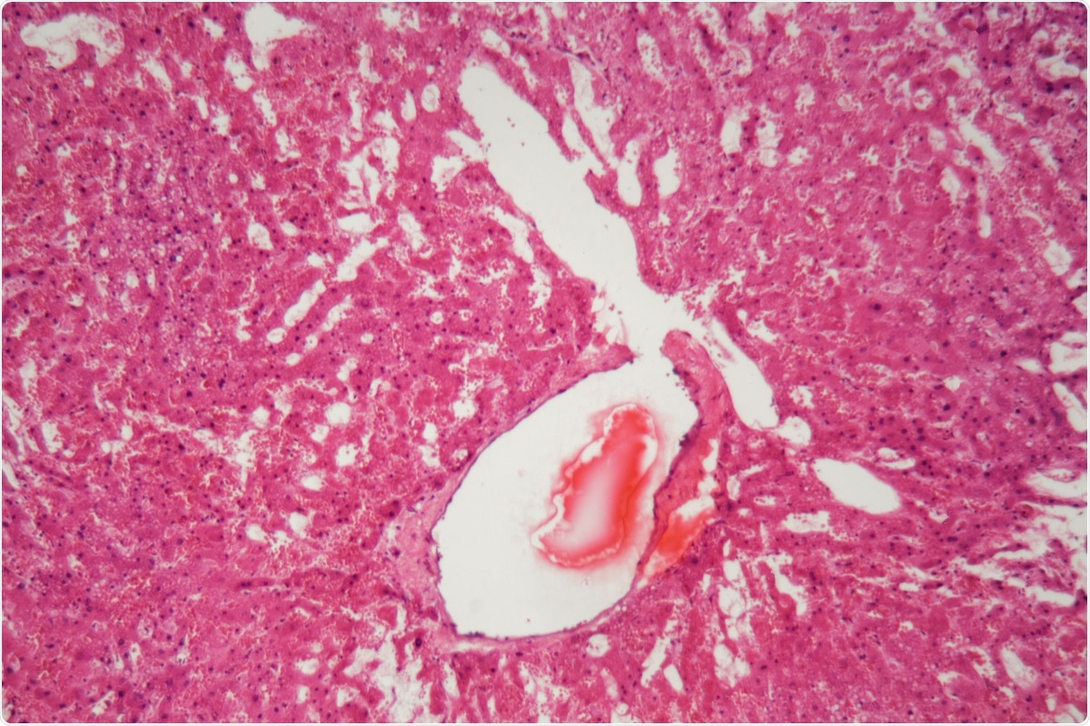 Study: The effect of SARS-COV-2 Infections on Amyloid Formation of Serum Amyloid A. Image Credit: ChWeiss / Shutterstock