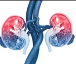 Acute Kidney Injury (AKI)