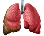 Mesothelioma Treatment