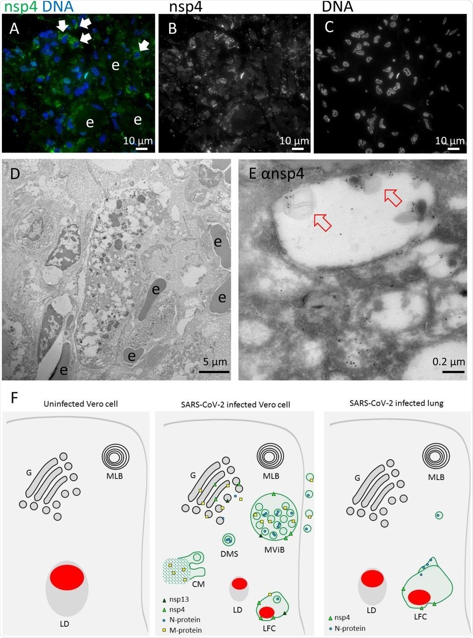 Non-structural protein 4 in e-lucent compartments infected lung. Lung tissue of COVID-19 patient 58 was either sectioned semi-thin for FM with A) nuclei, stained with Hoechst (blue), nsp4 stained with Alexa (green) in nsp4 positive cells indicated by white arrows and in black and white, and erythrocytes represented by e. Separate channels of nsp4 (B) and DNA (C). Ultrathin sections of infected lung immuno-gold labelled against nsp-4 and 10-nm gold particles in overview (D) and at higher magnification (E) e-lucent compartments with nsp4 labelling on membrane and lipid like structures (open red arrows) erythrocytes represented by e. F) Schematic representation of uninfected Vero cells, SARS-CoV-2 infected Vero cells and lung tissue of COVID-19 patient summarizing presence cellular organelles and subcellular localisation viral proteins. In black: host compartments, in green: viral compartments, in red: lipid like structures, CM convoluted membrane DMS: double membrane spherules, G: Golgi, LD: lipid droplet, MLB: multi-lamellar bodies, MViB: multi-virus body, LFC: lipid-filled compartment and immuno-labelling viral proteins: dark green triangle: nsp13, light green triangle: nsp4, blue circle: N-protein, yellow square: M-protein.