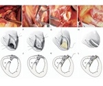 Novel surgical technique shows promise to repair ruptures caused by heart attacks
