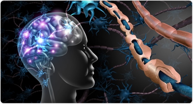 Multiple Sclerosis Concept