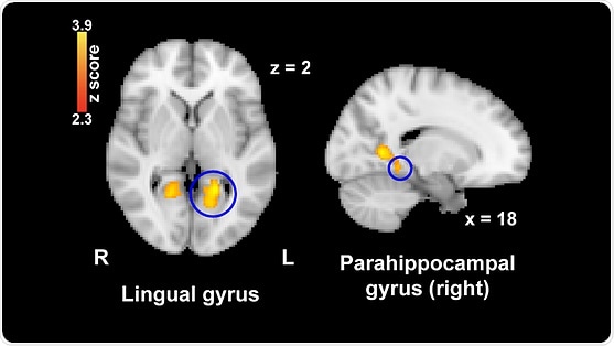 Viewing nostalgic images reduces pain perception