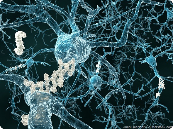 Alzheimers amyloid plaque