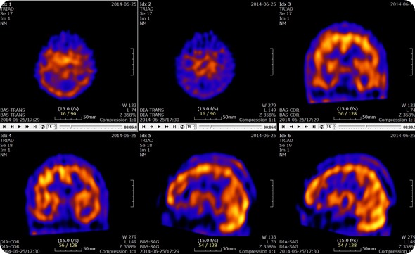 Brain SPECT with Acetazolamide Slices