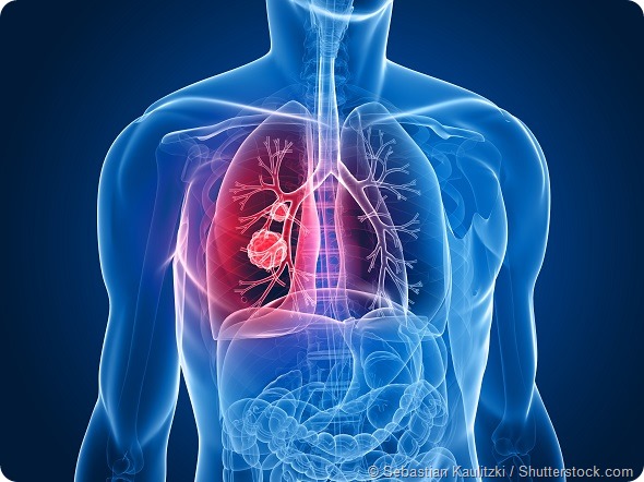 Lung Cancer