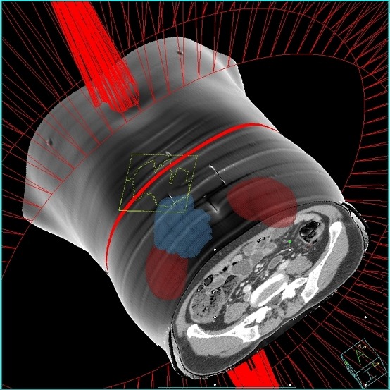 Philips Pinnacle3 SmartArc