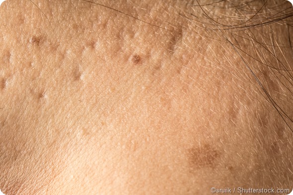 acne scars