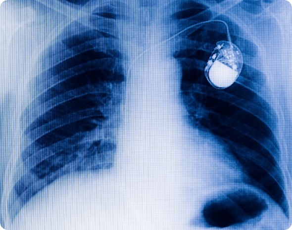 chest with the pacemaker on x-ray film