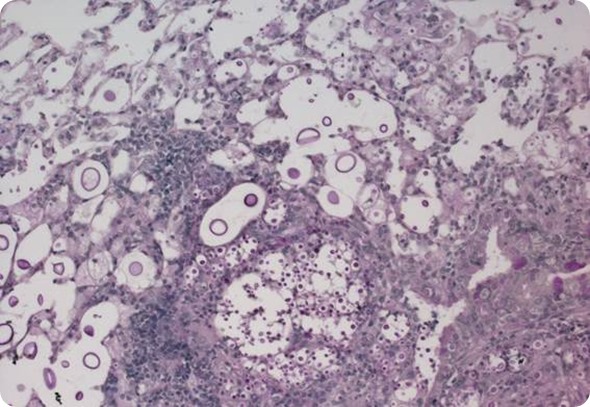 Histopathology section of lung alveolar spaces containing Cryptococcus titan and typical cells. Image courtesy of LH Okagaki and K Nielsen.