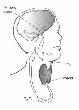 hypothyroidism