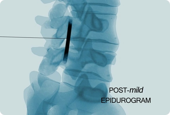 mild Post Procedure Imaging