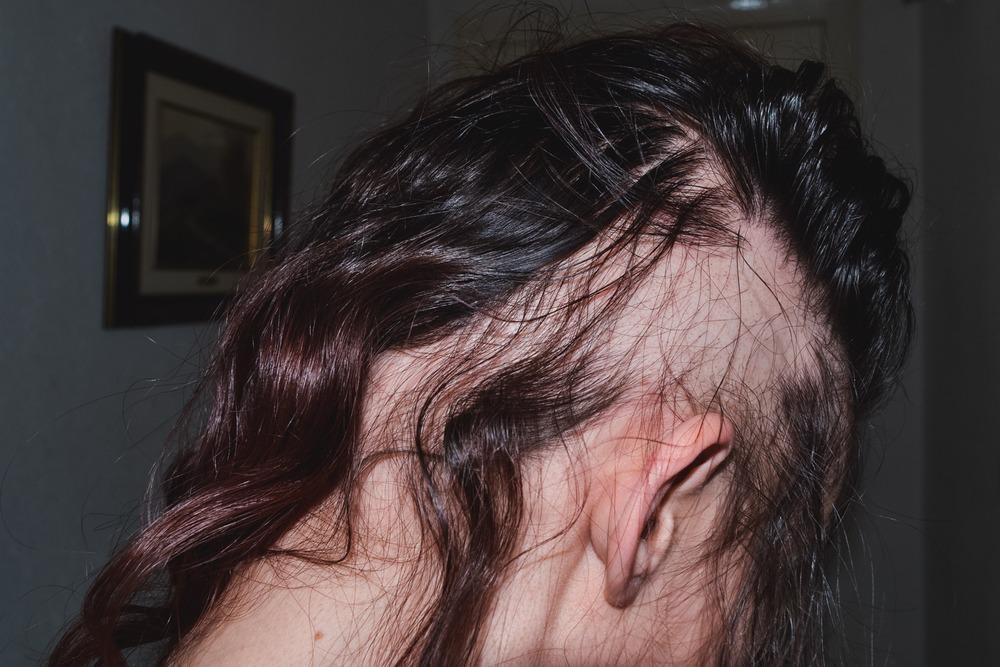 Alopecia