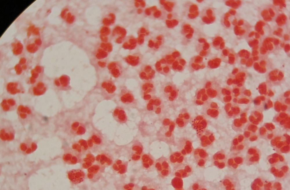 Gram stain Neisseria gonorrhoeae