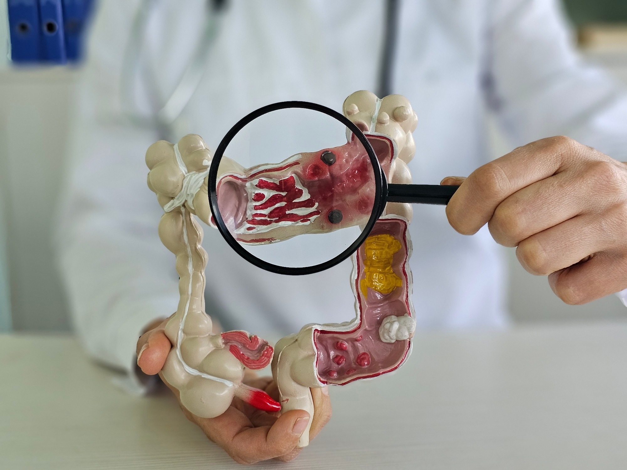 Magnifying glass and colon diseases and colorectal cancer and ulcerative colitis