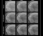 How denoising algorithms can improve MRI image quality