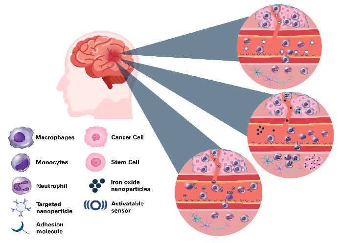 Approaches for cellular and molecular imaging of brain tumors. Top: Targeted MRI probes bind to receptors that are highly expressed in tumors, for example vascular adhesion molecules. Middle: Cell labeling and reporter genes can track the dynamics of immune cell trafficking and the fate of cell-based therapies. Cells can either be labeled with an MRI contrast agent, often an iron oxide nanoparticle, or be transfected with a plasmid containing a reporter gene. The gene product in the cells gives rise to a detectable MRI contrast. Labeled cells are either transplanted locally (e.g. stem cells) or are injected systematically (e.g. monocytes), where they migrate to their target site. Alternatively, nanoparticles are injected intravascularly where they are taken up by phagocytosing cells like macrophages. Bottom: Injected activatable sensors report enzyme activity, thus providing highly specific molecular markers of the tumor pathology