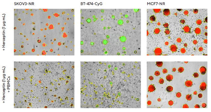 Impact of Herceptin-induced PBMCs on multi-spheroid proliferation. Tumor cells either stably expressing nuclear restricted RFP (SKOV3-NR, MCF7-NR) or cytoplasmically restricted GFP (BT-474-CyG) were seeded in flat bottom 96-well plates (1,000 cells/well on a bed of Matrigel). Multi-spheroids were allowed to form (3 d) prior to addition of freshly isolated PBMCs (E:T, 5:1) and Herceptin. Incucyte® S3 brightfield and fluorescence images (7 d; SKOV3-NR, MCF-NR or 10 d; BT-474-CyG) compare the effect of Herceptin on spheroid proliferation in absence (top panel) and presence (bottom panel) of PBMCs (Brightfield outline mask shown in yellow). Note the loss of fluorescence intensity in HER2- postive (SKOV3 and BT474) multi-spheroids in the presence of PBMCs