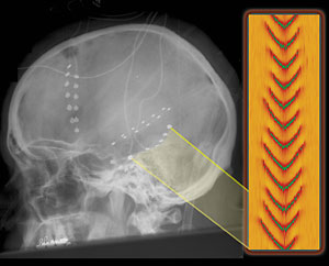 A lateral skull radiograph of an epilepsy patient with a series of electrodes implanted into his brain by Dr. Nicholas Barbaro at UCSF. The electrodes allowed neurologists to map the electrical activity produced during the patient