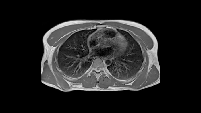 80 cm bore MAGNETOM Free.Max