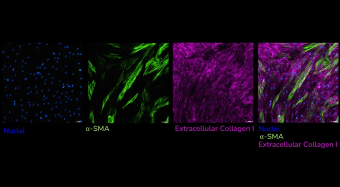 Human lung fibroblasts stimulated with TGF-β1 and immunostained to detect extracellular collagen I (pink) and α-SMA (green) as a measure of matrix production and fibroblast activation respectively. Images captured using using ImageXpress Confocal HT.ai imaging system, Scale bar: 50 µM
