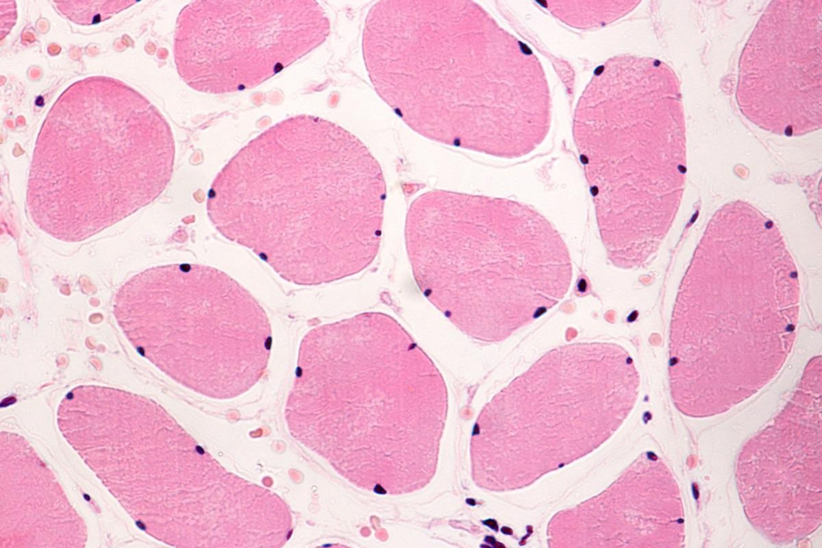 Study: Impact Of Sarcopenia In SARS-CoV-2 patients during two different epidemic waves. Image Credit: Jose Luis Calvo/Shutterstock