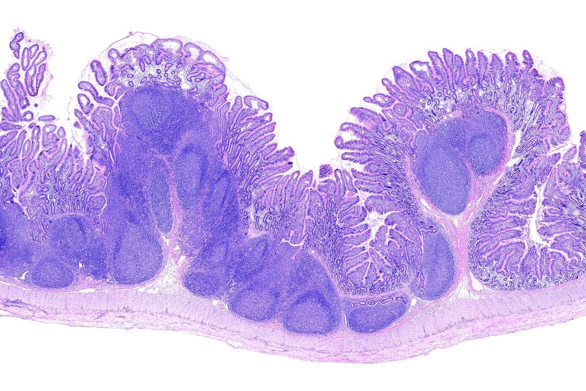Study: Disrupted Peyer