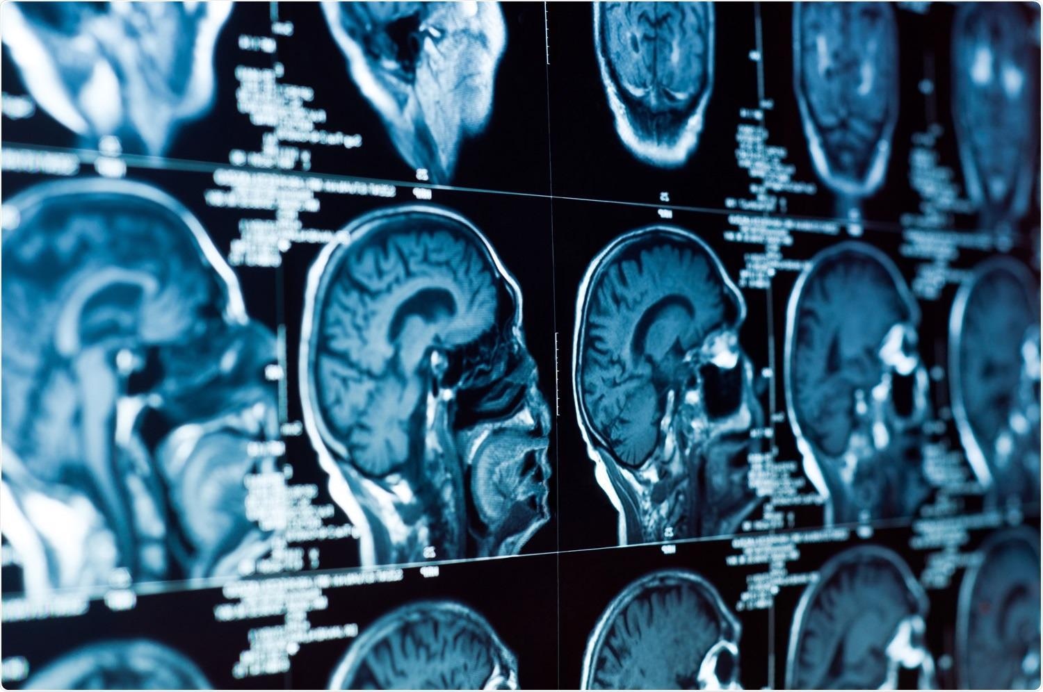 Study: Hospitalisation for COVID-19 predicts long-lasting cerebrovascular impairment: A prospective observational cohort study. Image Credit: SvedOliver / Shutterstock