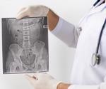 Study explores COVID-19 vaccine effectiveness in ankylosing spondylitis patients